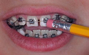 brackets